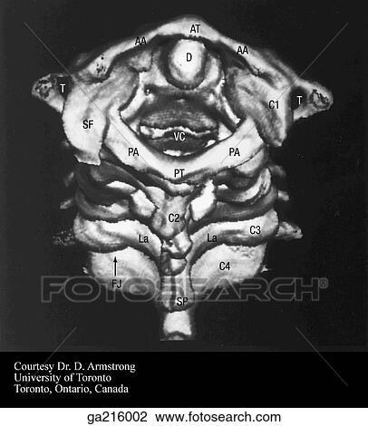 Three-dimensional computer-generated image of cervical spine, pos. view (D, dens; AT, ant. arch; AA, ant. tubercle; T, foramen transversarium; SF, sup. articular facet; PA, pos. arch; PT, pos. tubercle; La, lamina; S, spinal cord). View Large Illustration Drawing - Three-dimensional computer-generated image of cervical spine, pos. view (D, dens; AT, ant. arch; AA, ant. tubercle; T, foramen transversarium; SF, sup. articular facet; PA, pos. arch; PT, pos. tubercle; La, lamina; S, spinal cord).. Fotosearch