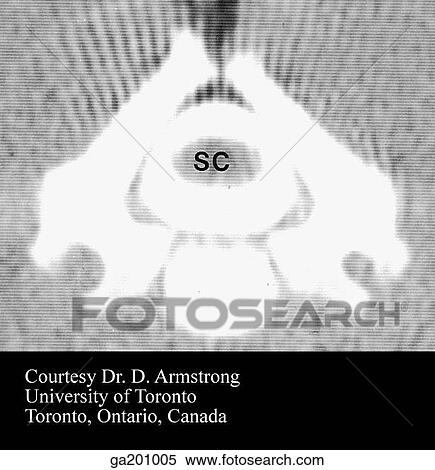 Stock Illustration - Transverse CT scan of vertebra at birth, showing the three bony parts and the contrast material around the spinal cord, filling the dural sac.. Fotosearch