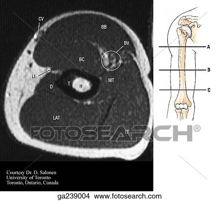 Stock Illustration - Transverse MRI of arm at mid humerus: BB, biceps brachii; BV, brachial vessels/nerves; MT, medial head of triceps; BC, brachialis; T, deltoid tuberosity; H, humerus; D, deltoid; LAT, lateral head triceps; LT, long head triceps; LI, lateral intermuscular s. Fotosearch