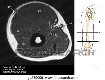Stock Illustration - Transverse MRI of arm just above elbow: CV, cephalic vein; BB, biceps brachii; BR, brachioradialis; BC, brachialis; BV, brachial vessels/nerves; MI, medial intermuscular septum; BS, basilic vein. See insert; C.. Fotosearch