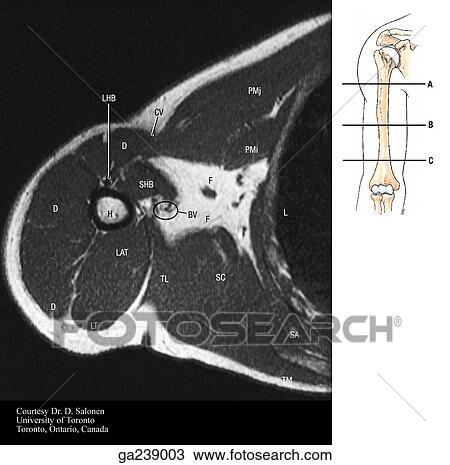 Transverse MRI of arm: LHB, long head; D, deltoid; LT, long head; LAT, lateral head; SHB, short head; CV, cephalic vein; PMj, pectoralis major; PMi. pectoralis minor; F, fat; BV, brachial vessels/nerves; TL, teres major/lat. dorsi; SC, subscapularis; L, l View Large Illustration Drawing - Transverse MRI of arm: LHB, long head; D, deltoid; LT, long head; LAT, lateral head; SHB, short head; CV, cephalic vein; PMj, pectoralis major; PMi. pectoralis minor; F, fat; BV, brachial vessels/nerves; TL, teres major/lat. dorsi; SC, subscapularis; L, l. Fotosearch
