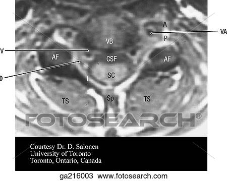 Drawing - Transverse MRI of cervical spine (VB, vertebral body; A, ant. tubercle; AF, articular facet; CSF, cerebrospinal fluid; SC, spinal cord; L, lamina; TS, transversospinalis muscles; Sp, spinous process).. Fotosearch