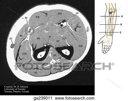 Transverse MRI of forearm: CV, cephalic v; FCR, flex carpi rad; RV, radial vessels; FDS, flex dig super; UV, ulnar vessels; FCU, flex carpi ulnaris; AV, ant interos vessels; INT, interos mem; FDP, flex dig profundus; FPL, flex pol long; U, ulna; R, radius View Large Illustration Clip Art - Transverse MRI of forearm: CV, cephalic v; FCR, flex carpi rad; RV, radial vessels; FDS, flex dig super; UV, ulnar vessels; FCU, flex carpi ulnaris; AV, ant interos vessels; INT, interos mem; FDP, flex dig profundus; FPL, flex pol long; U, ulna; R, radius. Fotosearch