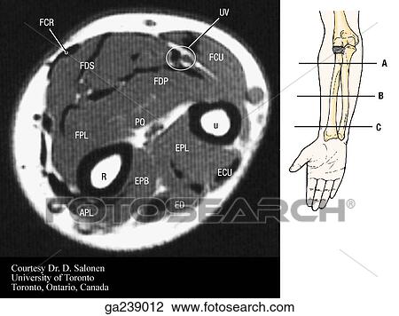 Transverse MRI of forearm: FCR/FCU, flex. carpi rad/ulnaris; FDS/FDP, flex dig super/profun; UV, ulnar ves.; PQ, pronator quadratus; FPL, flex pol longus; EPL/EPB, ext pol longus/brev; ECU, ext carpi ulnaris; ED, ext dig; R, radius; APL, abd pol long; U, View Large Illustration Drawing - Transverse MRI of forearm: FCR/FCU, flex. carpi rad/ulnaris; FDS/FDP, flex dig super/profun; UV, ulnar ves.; PQ, pronator quadratus; FPL, flex pol longus; EPL/EPB, ext pol longus/brev; ECU, ext carpi ulnaris; ED, ext dig; R, radius; APL, abd pol long; U, . Fotosearch