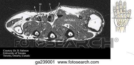 Transverse MRI through adductor pollicis; for level of section, see insert (line B): D1-D4, dorsal interossei; P1-P3, palmar interossei; 1, lumbrical; 2, digital a. /n.; 3, palmar apo; 4, flex pol long; 5, abd pol brev; 6, sesamoid; 7, ext tend; 8, abd dig View Large Illustration Clip Art - Transverse MRI through adductor pollicis; for level of section, see insert (line B): D1-D4, dorsal interossei; P1-P3, palmar interossei; 1, lumbrical; 2, digital a. /n.; 3, palmar apo; 4, flex pol long; 5, abd pol brev; 6, sesamoid; 7, ext tend; 8, abd dig. Fotosearch