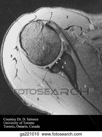 Clipart - Transverse MRI through shoulder joint and axilla (1, greater tubercle; 2, biceps brachii; 3, glenoid labrum; 4, glenoid fossa of scapula; 5, head of humerus; 6, subscapularis; 7, infraspinatus; 8, deltoid).. Fotosearch