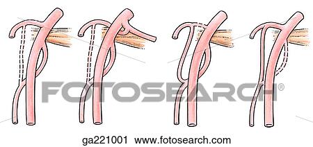 Clip Art - Variations in origin of the posterior circumflex humeral and profunda brachii arteries. In specimens studied, the variations as shown in this image occurred in 59. 6% (left image), 16. 6% (2nd image), 14. 5% (3rd image), and 6. 4% (right image).. Fotosearch