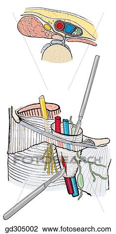 Cortada veia femoral