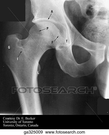 Stock Illustration - Anteroposterior radiography of hip.. Fotosearch