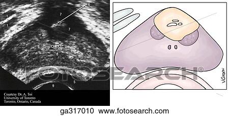 Axial (transverse) transrectal ultrasound scans through prostate. A. Normal prostate of young male. View Large Illustration Clipart - Axial (transverse) transrectal ultrasound scans through prostate. A. Normal prostate of young male.. Fotosearch