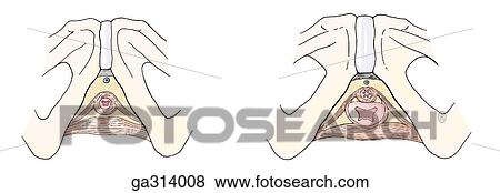 Stock Illustration - B. External urethral sphincter, compressor urethrae and urethrovaginal sphincter, inferior views.. Fotosearch