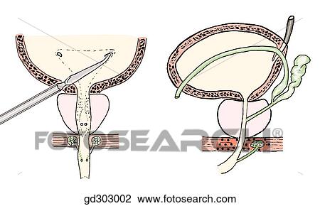 Bladder, prostate, deep perineal space, and proximal portion of male urethra on frontal section and in left lateral view. The probe is located at the left ureteric orifice. View Large Illustration Drawing - Bladder, prostate, deep perineal space, and proximal portion of male urethra on frontal section and in left lateral view. The probe is located at the left ureteric orifice.. Fotosearch
