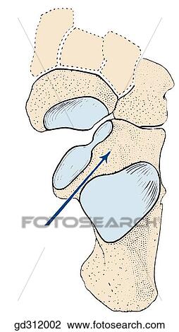 Bones of the foot on dorsal view. The talus has been removed to show where inversion and eversion take place. View Large Illustration Drawing - Bones of the foot on dorsal view. The talus has been removed to show where inversion and eversion take place.. Fotosearch