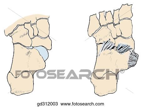 Bones of the foot on plantar view. Plantar ligaments of joints of inversion and eversion. View Large Illustration Drawing - Bones of the foot on plantar view. Plantar ligaments of joints of inversion and eversion.. Fotosearch