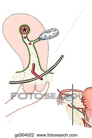 Broad ligament of uterus, its subdivisions and chief relations (paramedian section). Note the proximity of ureter and uterine artery. The blue line indicates the paramedian section through the broad ligament. View Large Illustration Drawing - Broad ligament of uterus, its subdivisions and chief relations (paramedian section). Note the proximity of ureter and uterine artery. The blue line indicates the paramedian section through the broad ligament.. Fotosearch