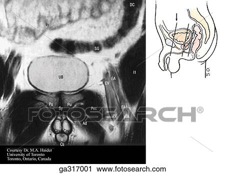 Coronal MRIs (magnetic resonance images) of the male pelvis and perineum. A. Insert image indicates level of MRI. View Large Illustration Clip Art - Coronal MRIs (magnetic resonance images) of the male pelvis and perineum. A. Insert image indicates level of MRI.. Fotosearch