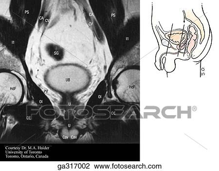Drawing - Coronal MRIs (magnetic resonance images) of the male pelvis and perineum. B. Insert image indicates level of MRI.. Fotosearch