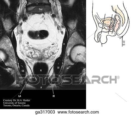 Drawing - Coronal MRIs (magnetic resonance images) of the male pelvis and perineum. C. Insert image indicates level of MRI.. Fotosearch