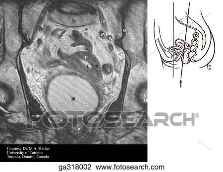 Coronal MRIs (magnetic resonance images) of the female pelvis and perineum. B. Insert image indicates level of MRI. View Large Illustration Drawing - Coronal MRIs (magnetic resonance images) of the female pelvis and perineum. B. Insert image indicates level of MRI.. Fotosearch