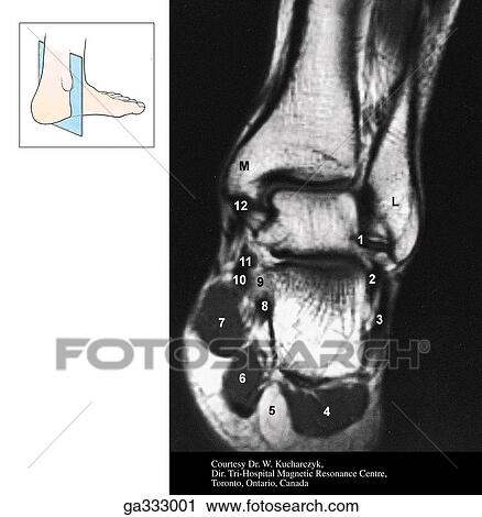 Clip Art - Coronal section and MRI through ankle. B. Coronal MRI (Numbers in B refer to structures labeled in A. ) Insert image indicates level of MRI.. Fotosearch
