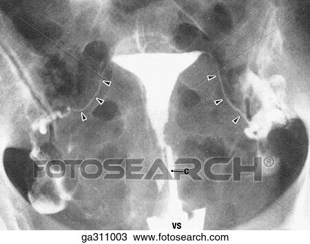 Drawing - Female pelvis: B. Hysterosalpingogram. Radiopaque contrast medium was injected via cannula (C) into the uterus through the external ostium; VS, vaginal speculum in vagina. The triangular uterine cavity is clearly outlined.. Fotosearch