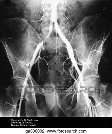 Iliac anteriogram, anteroposterior view. View Large Illustration Drawing - Iliac anteriogram, anteroposterior view.. Fotosearch