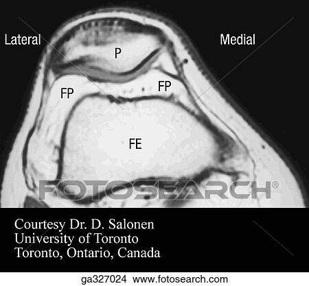 Imaging of patellofemoral articulation. A. Transverse MRI. View Large Illustration Stock Illustration - Imaging of patellofemoral articulation. A. Transverse MRI.. Fotosearch
