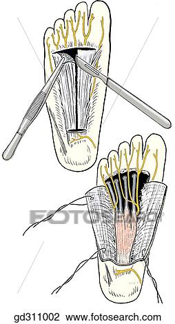 Incision in plantar aponeurosis, reflection of aponeurorsis and exposure of underlying flexor digitorum brevis. Cutaneous nerves of sole of foot. View Large Illustration Drawing - Incision in plantar aponeurosis, reflection of aponeurorsis and exposure of underlying flexor digitorum brevis. Cutaneous nerves of sole of foot.. Fotosearch