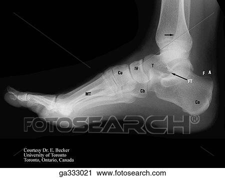 Clip Art - Lateral view of foot; A, Achilles tendon; Ca, Calcanues; Cb, cuboid; Cu, Cuniforms; F, Fat; MT, Metatarsal; S, Sustentalculum; T, Talus.. Fotosearch