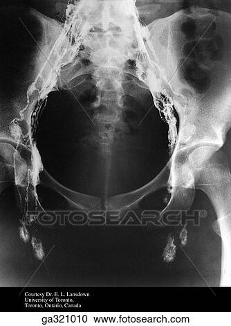 Clipart - Lymph nodes. A. Injection, anterioposterior radiograph.. Fotosearch