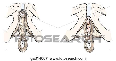 Male and female perineum, inferior views. E. Muscles of superficial perineal compartment. View Large Illustration Stock Illustration - Male and female perineum, inferior views. E. Muscles of superficial perineal compartment.. Fotosearch