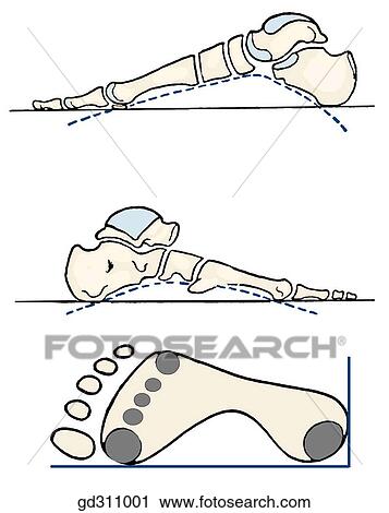 Medial and lateral longitudinal arches of the foot. Bearing points of the foot. View Large Illustration Clip Art - Medial and lateral longitudinal arches of the foot. Bearing points of the foot.. Fotosearch