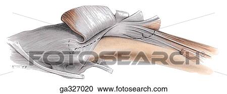 Clipart - Medial aspect of knee. C. Articularis genu muscle. This muscle, deep to the vastus intermedius muscle, consists of a few fibers arising from the anterior surface of the femur and inserting into the synovial capsule of the knee joint, which it retracts dur. Fotosearch