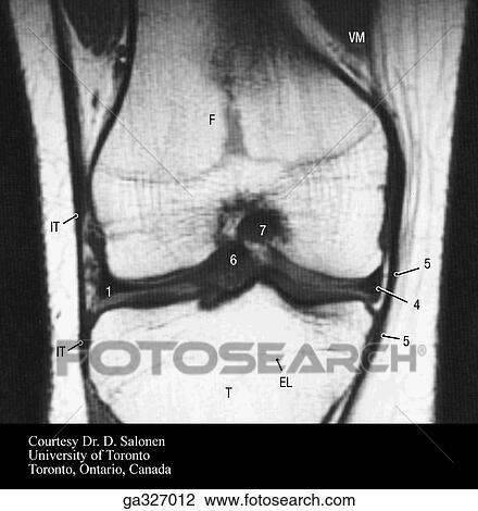 MRI of knee. B. MRI through intercondylar notch of femur, tibia and fibula. View Large Illustration Drawing - MRI of knee. B. MRI through intercondylar notch of femur, tibia and fibula.. Fotosearch