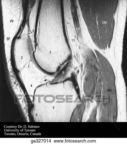MRI of knee. B. MRI through medial aspect of intercondylar notch of femur. View Large Illustration Stock Illustration - MRI of knee. B. MRI through medial aspect of intercondylar notch of femur.. Fotosearch