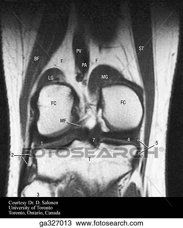 MRI of knee. C. MRI through femoral condyles tibia and fibula. Numbers in MRIs refer to structures in A. View Large Illustration Drawing - MRI of knee. C. MRI through femoral condyles tibia and fibula. Numbers in MRIs refer to structures in A.. Fotosearch