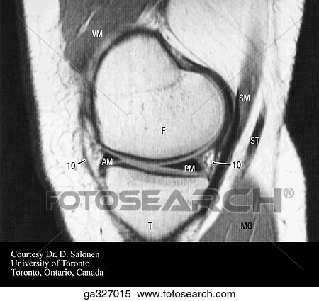 MRI of knee. C. MRI through medial femoral and tibia condyles. Numbers in MRIs refer to structures in A. View Large Illustration Stock Illustration - MRI of knee. C. MRI through medial femoral and tibia condyles. Numbers in MRIs refer to structures in A.. Fotosearch