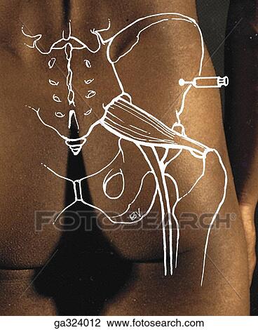 Muscles of gluteal region and posterior aspect of thigh - II, posterior view. B. Intragluteal injection. Injections can be made safely only into the superolateral part of the buttock, avoiding injury to the sciatic and gluteal nerves. View Large Illustration Drawing - Muscles of gluteal region and posterior aspect of thigh - II, posterior view. B. Intragluteal injection. Injections can be made safely only into the superolateral part of the buttock, avoiding injury to the sciatic and gluteal nerves.. Fotosearch