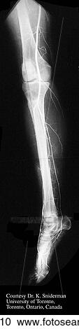 Popliteal arteriogram, oblique view. View Large Illustration Clipart - Popliteal arteriogram, oblique view.. Fotosearch