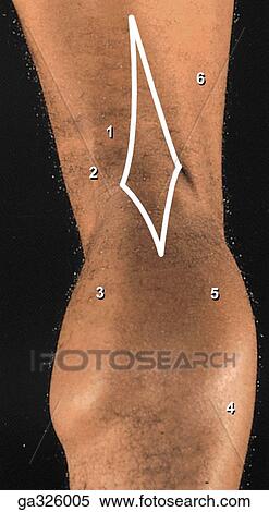 Popliteal Fossa. A. Surface anatomy. The hamstring muscles diverge: biceps to the fibula, and the semimembranosus and semitendinosus muscles to the tibia. The origins of the medial and lateral heads of the gastrocnemius are deep to the hamstrings. The dia View Large Illustration Stock Illustration - Popliteal Fossa. A. Surface anatomy. The hamstring muscles diverge: biceps to the fibula, and the semimembranosus and semitendinosus muscles to the tibia. The origins of the medial and lateral heads of the gastrocnemius are deep to the hamstrings. The dia. Fotosearch