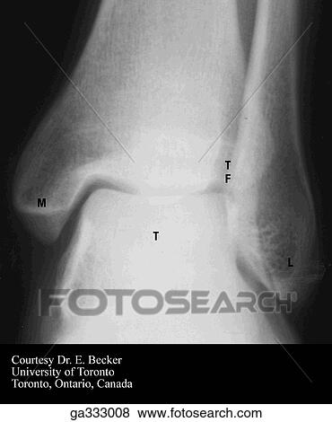 Stock Illustration - Radiographs of foot and ankle. Anterior view of ankle region.. Fotosearch