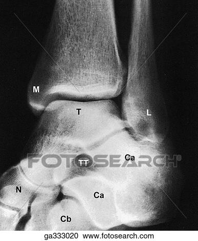 Clipart - Radiographs of foot and ankle. C. Lateral view of ankle region.. Fotosearch