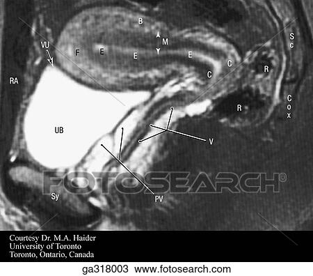 Drawing - Sagittal MRIs (magnetic resonance image) of female pelvis.. Fotosearch