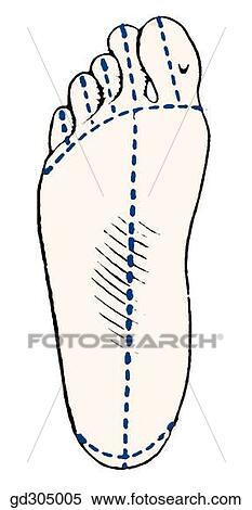 Skin Incisions. View Large Illustration Stock Illustration - Skin Incisions.. Fotosearch