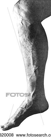 Superficial veins of lower limb. D. Medial view. View Large Illustration Stock Illustration - Superficial veins of lower limb. D. Medial view.. Fotosearch