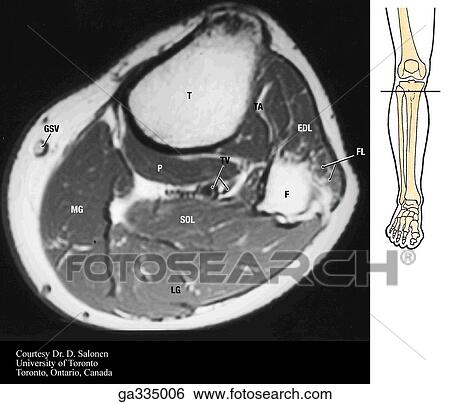 Stock Illustration - T1 axial (transverse) MRI of leg. A. Proximal. Insert image indicates level of MRI.. Fotosearch