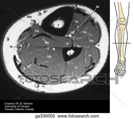 T1 axial (transverse) MRI of leg. B. Middle. Insert image indicates level of MRI. View Large Illustration Stock Illustration - T1 axial (transverse) MRI of leg. B. Middle. Insert image indicates level of MRI.. Fotosearch