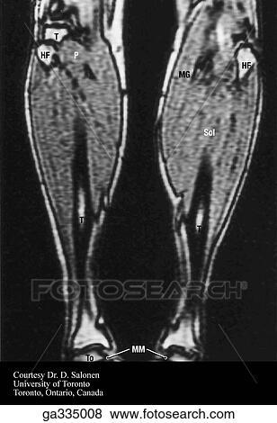 T1 axial (transverse) MRI of leg. B. Leg. View Large Illustration Stock Illustration - T1 axial (transverse) MRI of leg. B. Leg.. Fotosearch
