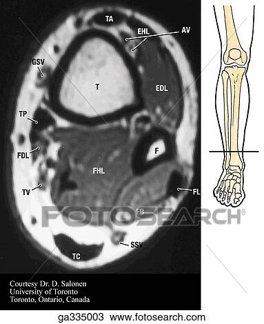 T1 axial (transverse) MRI of leg. C. Distal. Insert image indicates level of MRI. View Large Illustration Drawing - T1 axial (transverse) MRI of leg. C. Distal. Insert image indicates level of MRI.. Fotosearch