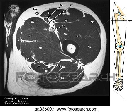 T1 axial (transverse) MRI of thigh. A. Proximal. Insert image indicates level of MRI. View Large Illustration Stock Illustration - T1 axial (transverse) MRI of thigh. A. Proximal. Insert image indicates level of MRI.. Fotosearch